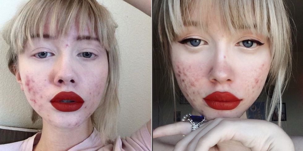 Acne Positivity: Why People Are Posting Selfies on Instagram