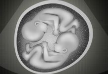 Australia semi-identical twins born, “third form of twinning,” Australia semi-identical twins born, “third form of twinning,”