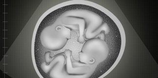 Australia semi-identical twins born, “third form of twinning,” Australia semi-identical twins born, “third form of twinning,”