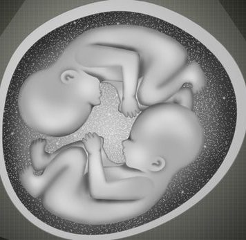 Australia semi-identical twins born, “third form of twinning,” Australia semi-identical twins born, “third form of twinning,”