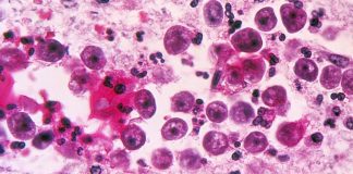 Brain-eating amoeba case confirmed in Florida, Report