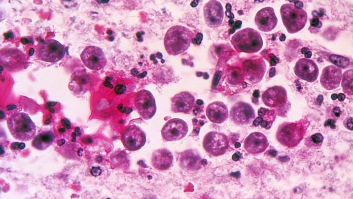 Brain-eating amoeba case confirmed in Florida, Report