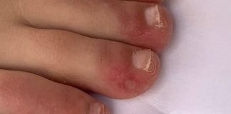 Coronavirus: What is the new ‘unusual’ and painful skin symptom for COVID-19?