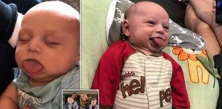Boy, 3, was born with a tongue FOUR times too big for his mouth (Picture) Boy, 3, was born with a tongue FOUR times too big for his mouth (Picture)