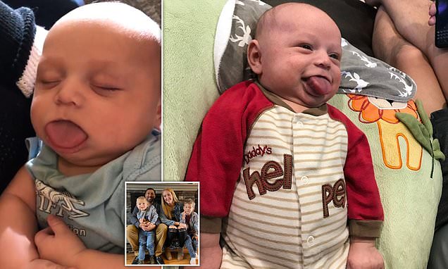 Boy, 3, was born with a tongue FOUR times too big for his mouth (Picture)