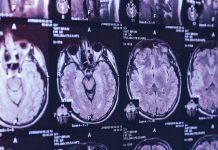 Canada: Mystery brain syndrome baffles doctors in New Brunswick Canada: Mystery brain syndrome baffles doctors in New Brunswick