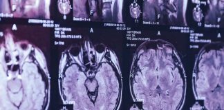 Canada: Mystery brain syndrome baffles doctors in New Brunswick