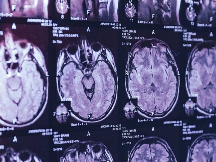 Canada: Mystery brain syndrome baffles doctors in New Brunswick